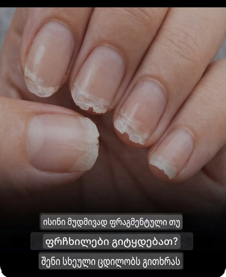 სუსტი ან მსხვრევადი ფრჩხილები: რას ცდილობს გითხრათ თქვენი სხეული?